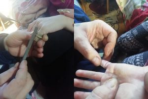 Спасатели МАСС вытащили палец 6-летней девочки из бинокля