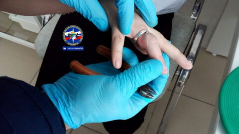 Новосибирской школьнице кольцо травмировало безымянный палец