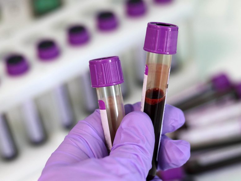 Простой анализ крови может точно выявить лежащую в основе нейродегенерацию