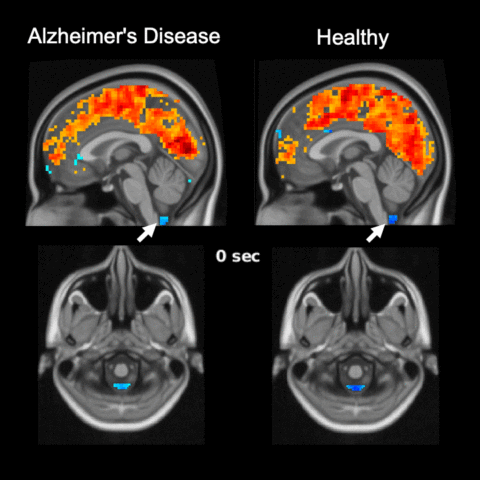 Доказательства зависимости мозга в очищении от токсичных белков и профилактике болезни Альцгеймера